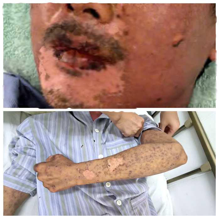 Silicon chống dột từ mái tôn rơi vào người, nam thợ sắt bị sốc phản vệ- Ảnh 1. Silicon chống dột từ mái tôn rơi vào người, nam thợ sắt bị sốc phản vệ- Ảnh 1.